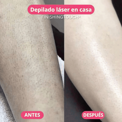 DEPILADORA LÁSER CORPORAL
